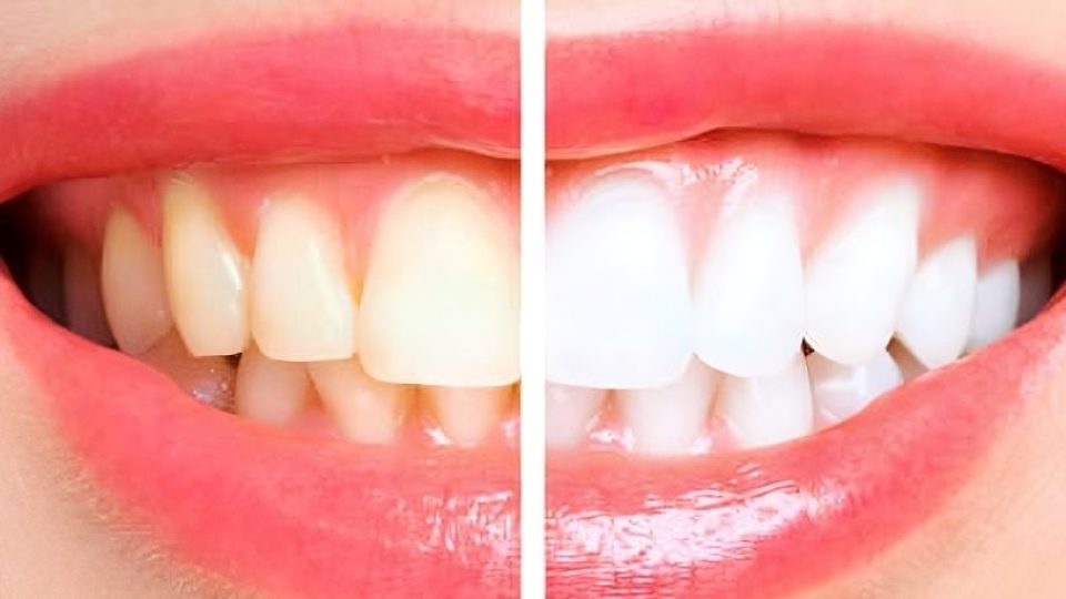 Bleaching / Teeth Whitening