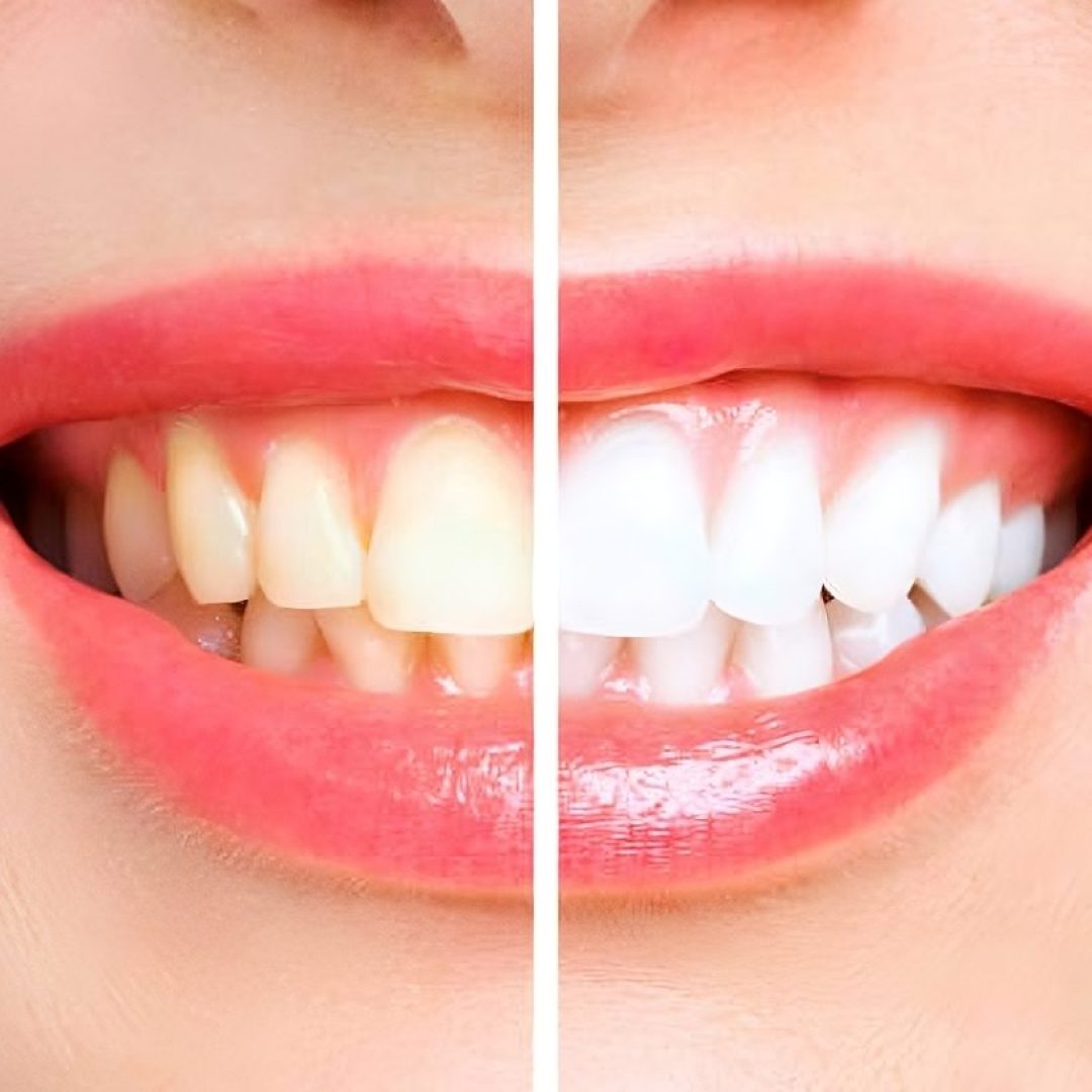 Bleaching / Teeth Whitening